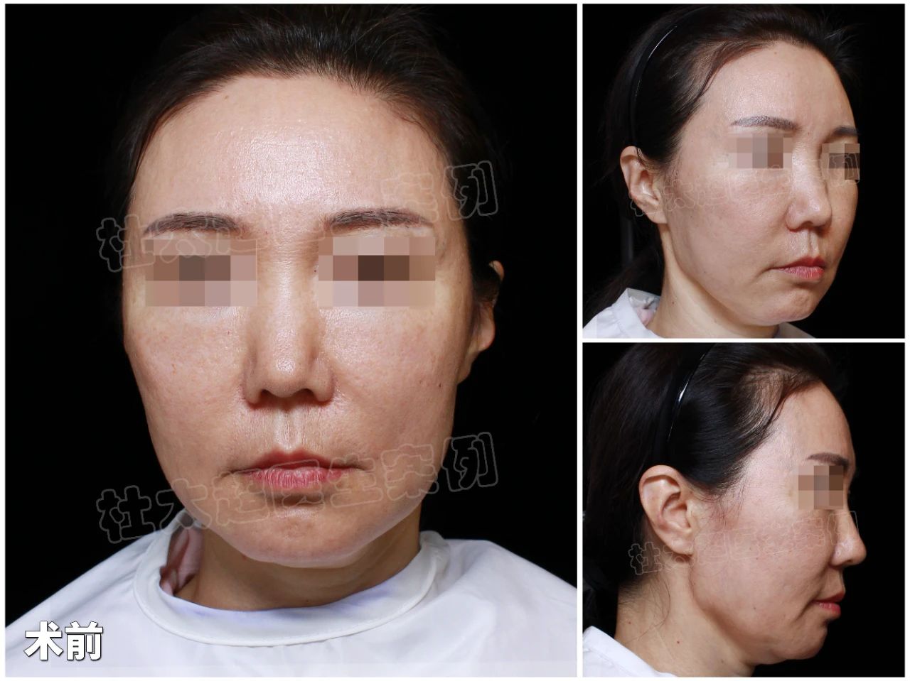 49岁变29岁？拉皮手术竟能让她拥有如此惊艳的面部线条？术后三个月大曝光！