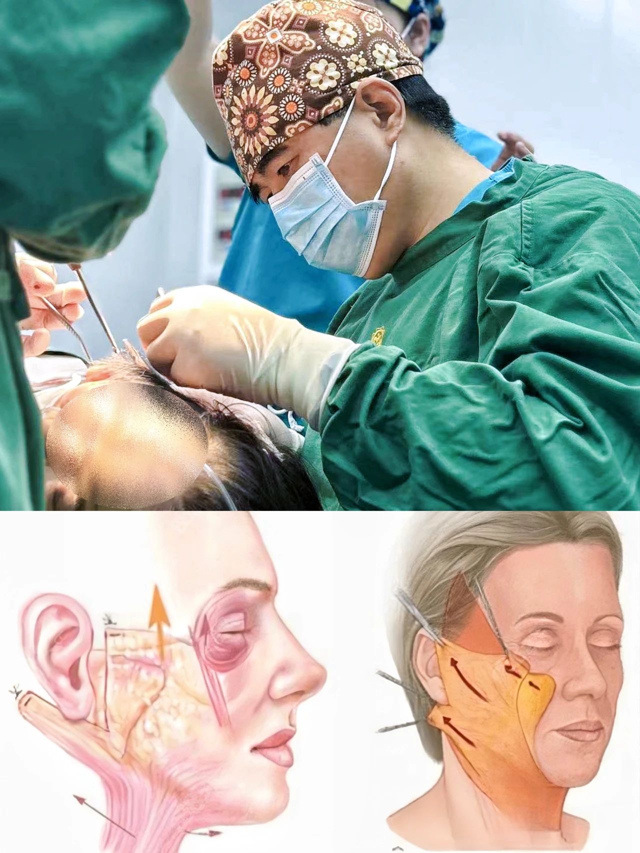 松弛导致的大方脸?拉皮手术能否成为你的救星? 松弛导致的大方脸?拉皮手术能否成为你的救星?