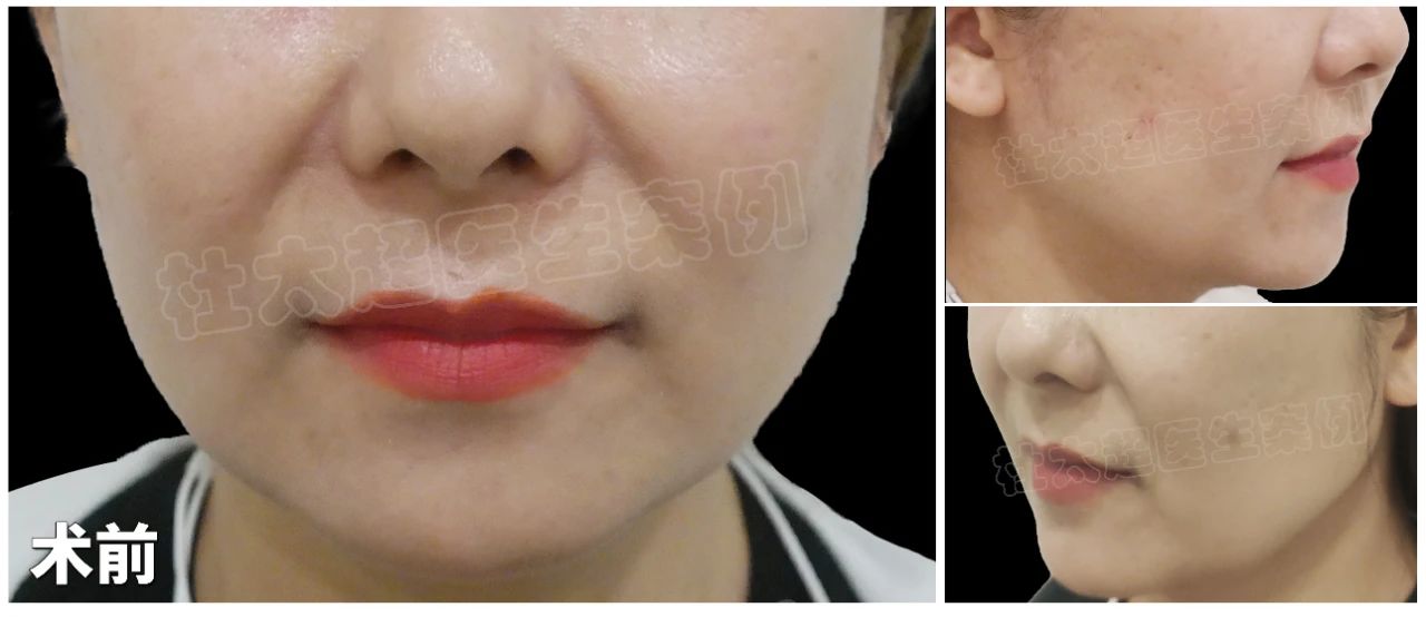 1句无心嘲讽,驱使她进行拉皮手术,48岁历经50天,实现惊人100%逆龄效果! 1句无心嘲讽,驱使她进行拉皮手术,48岁历经50天,实现惊人100%逆龄效果!