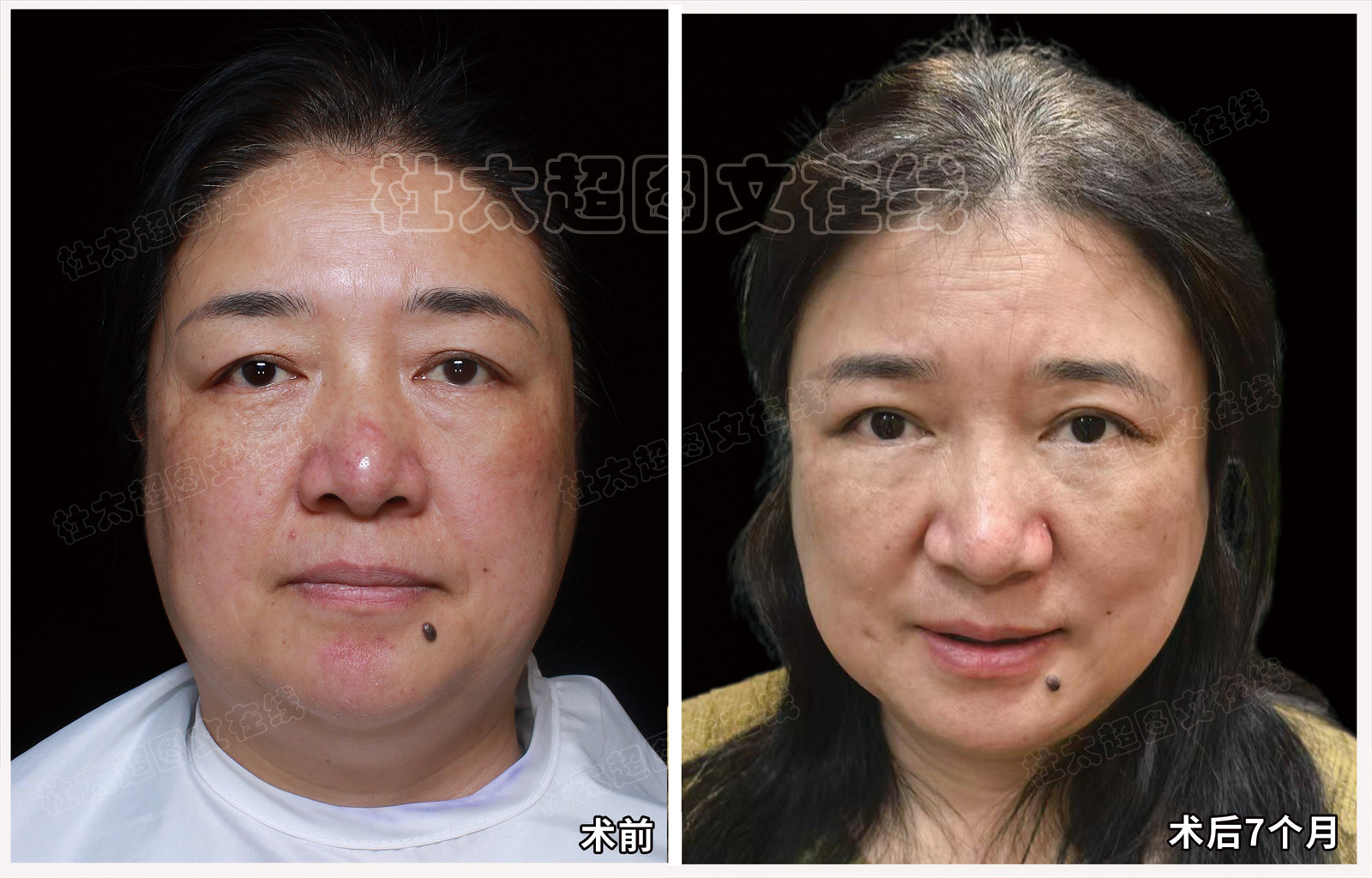 眼皮提升眼袋去除术后7个月