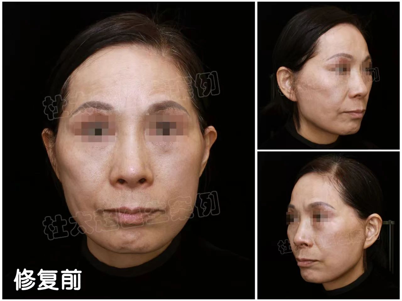 没想到！医生也会贪便宜吃大亏，2次拉皮手术的惨痛教训值得让人深刻反思！