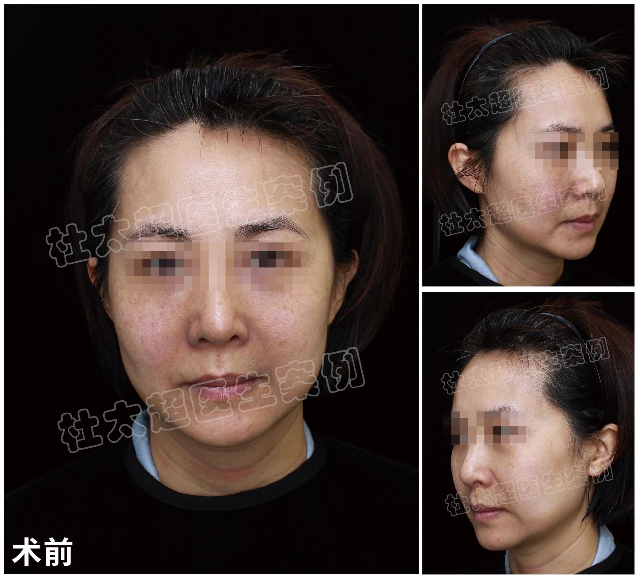 真没想到!我做完拉皮手术后,身边人居然集体抑郁了?是“惊艳”还是“惊吓”! 真没想到!我做完拉皮手术后,身边人居然集体抑郁了?是“惊艳”还是“惊吓”!