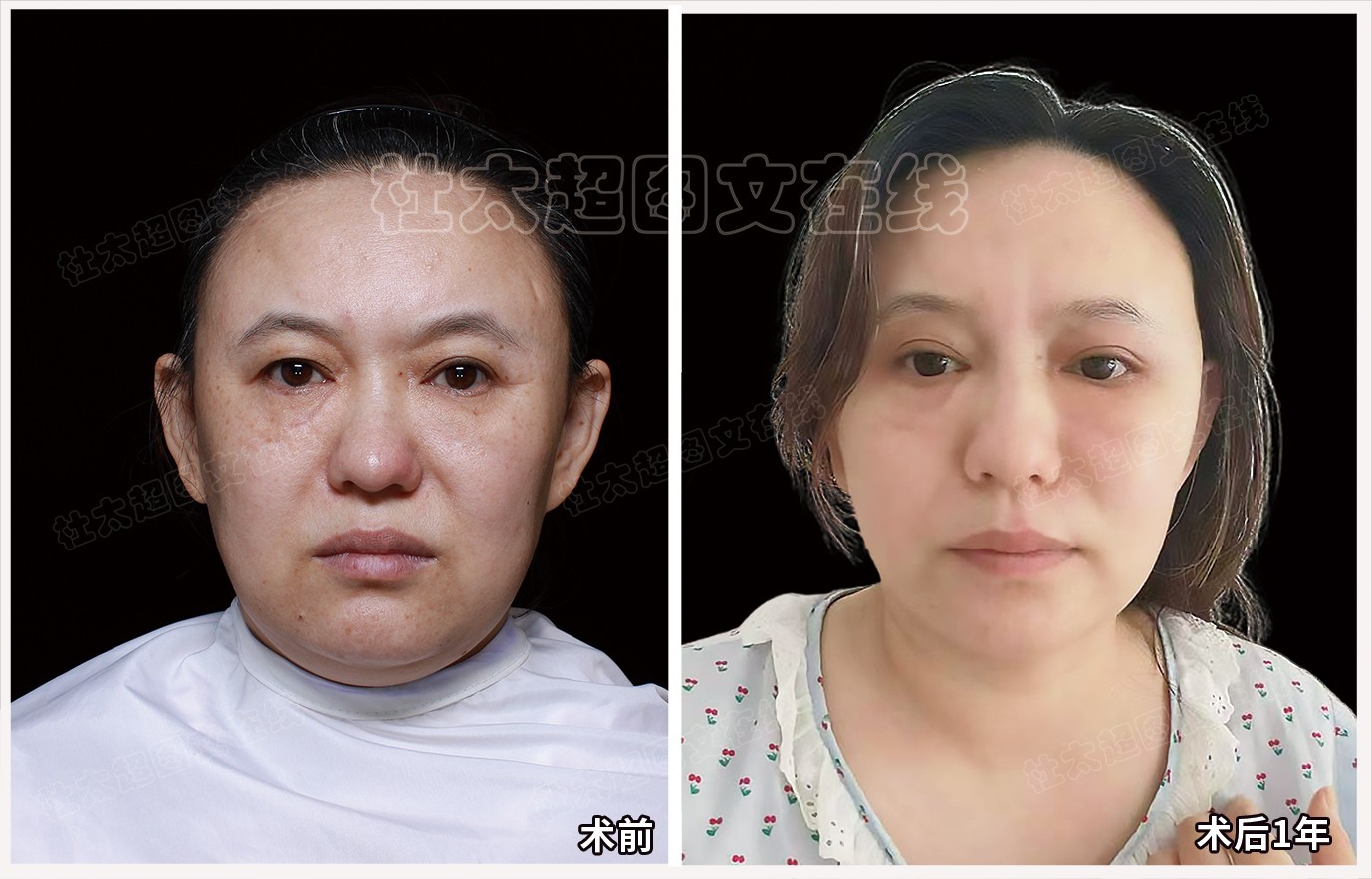 郭娟术后1年.jpg