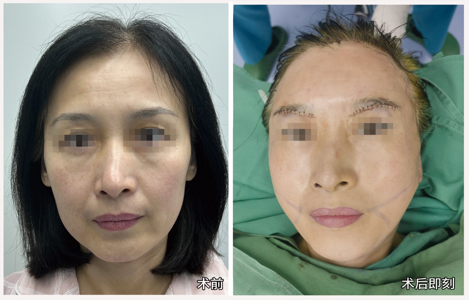 术后无水印.jpg