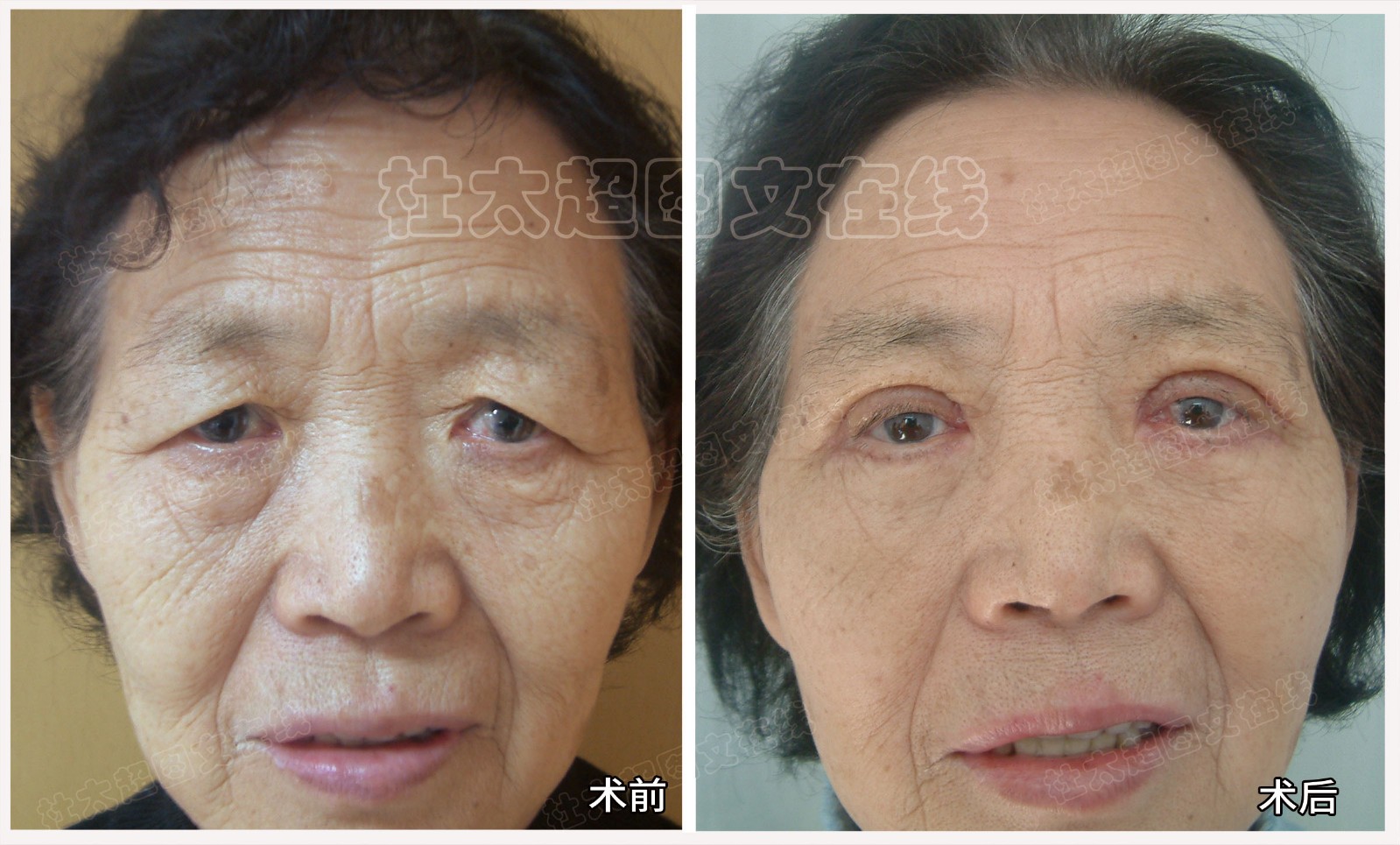 眼袋对比.jpg