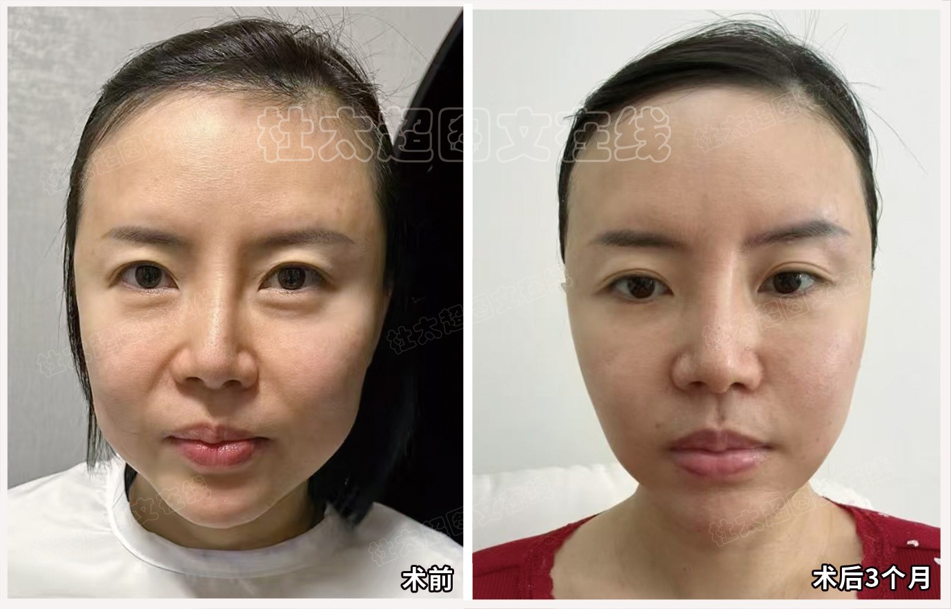 赵莹莹术后3个月.jpg