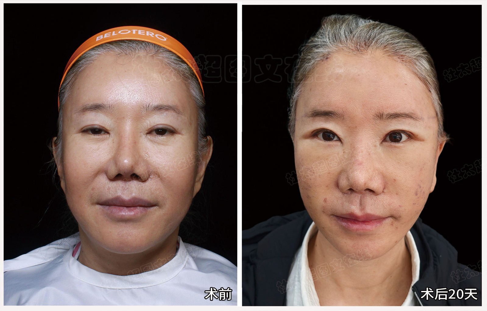 韩洪萍术后20天.jpg