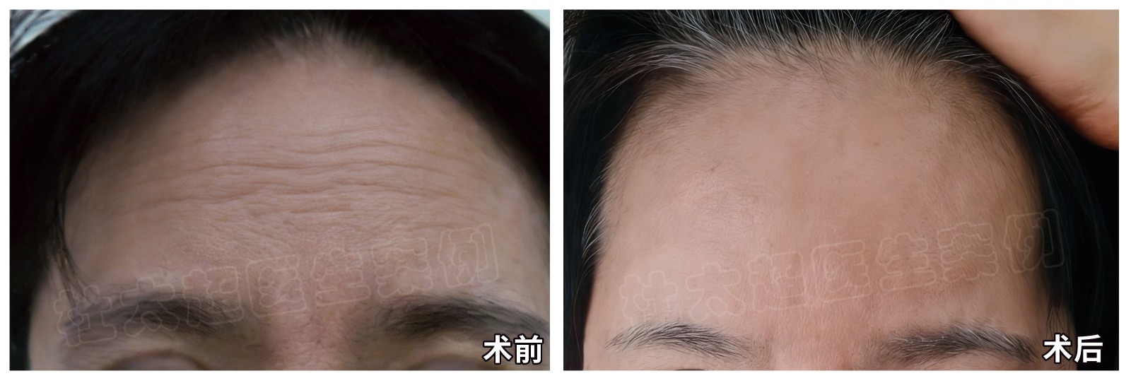 额部局部术前+术后.jpg