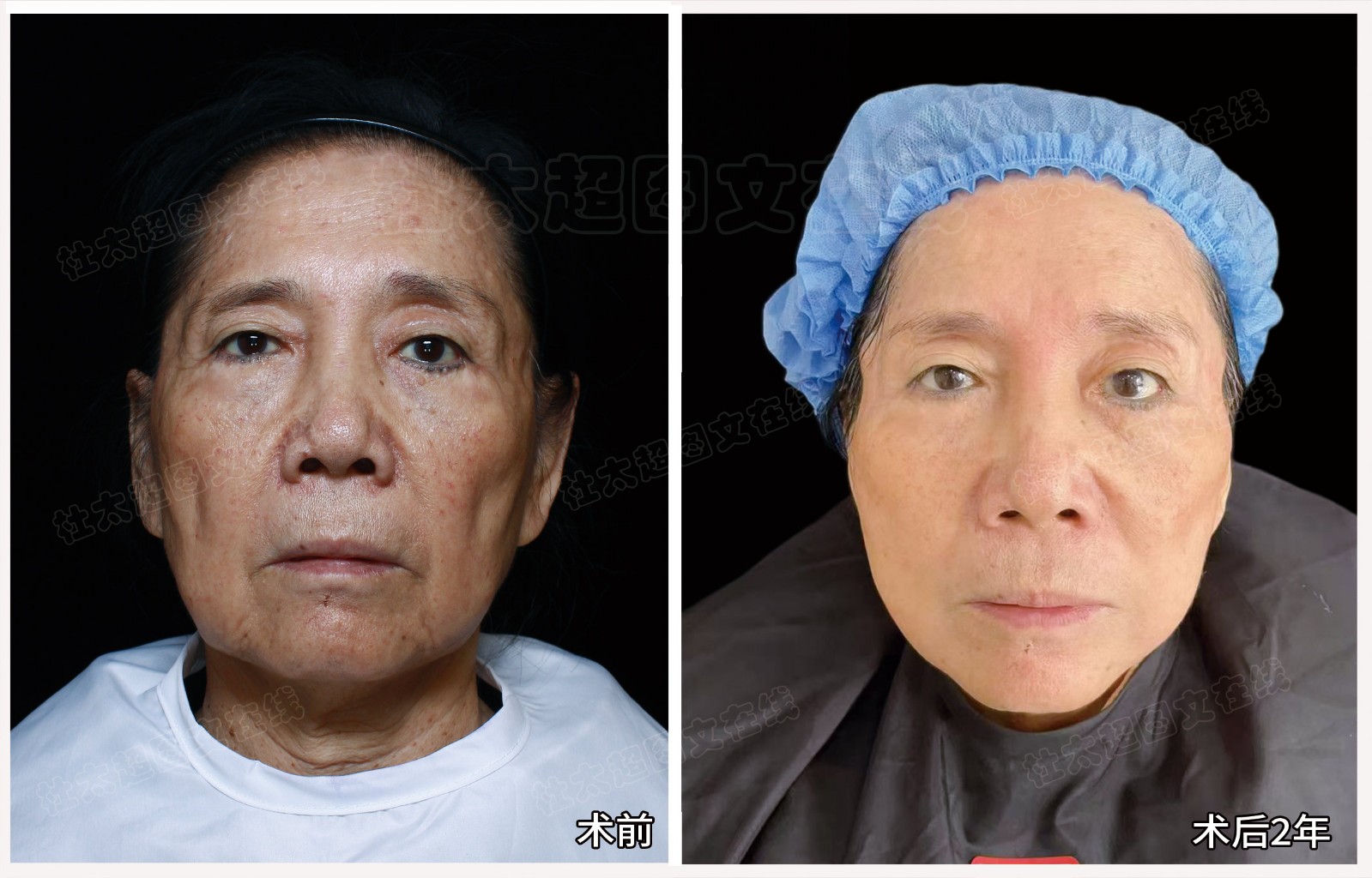 吕素端术后2年.jpg