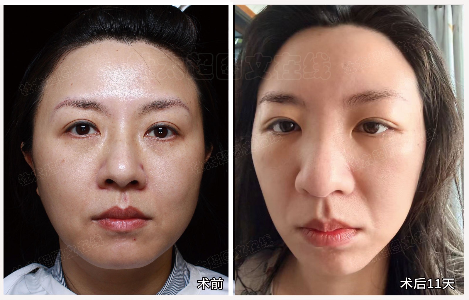 蒋欣庭术后11天.jpg