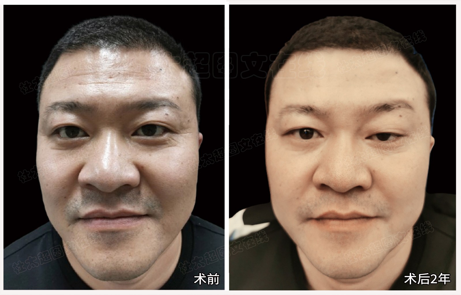额纹去除术后2年.jpg