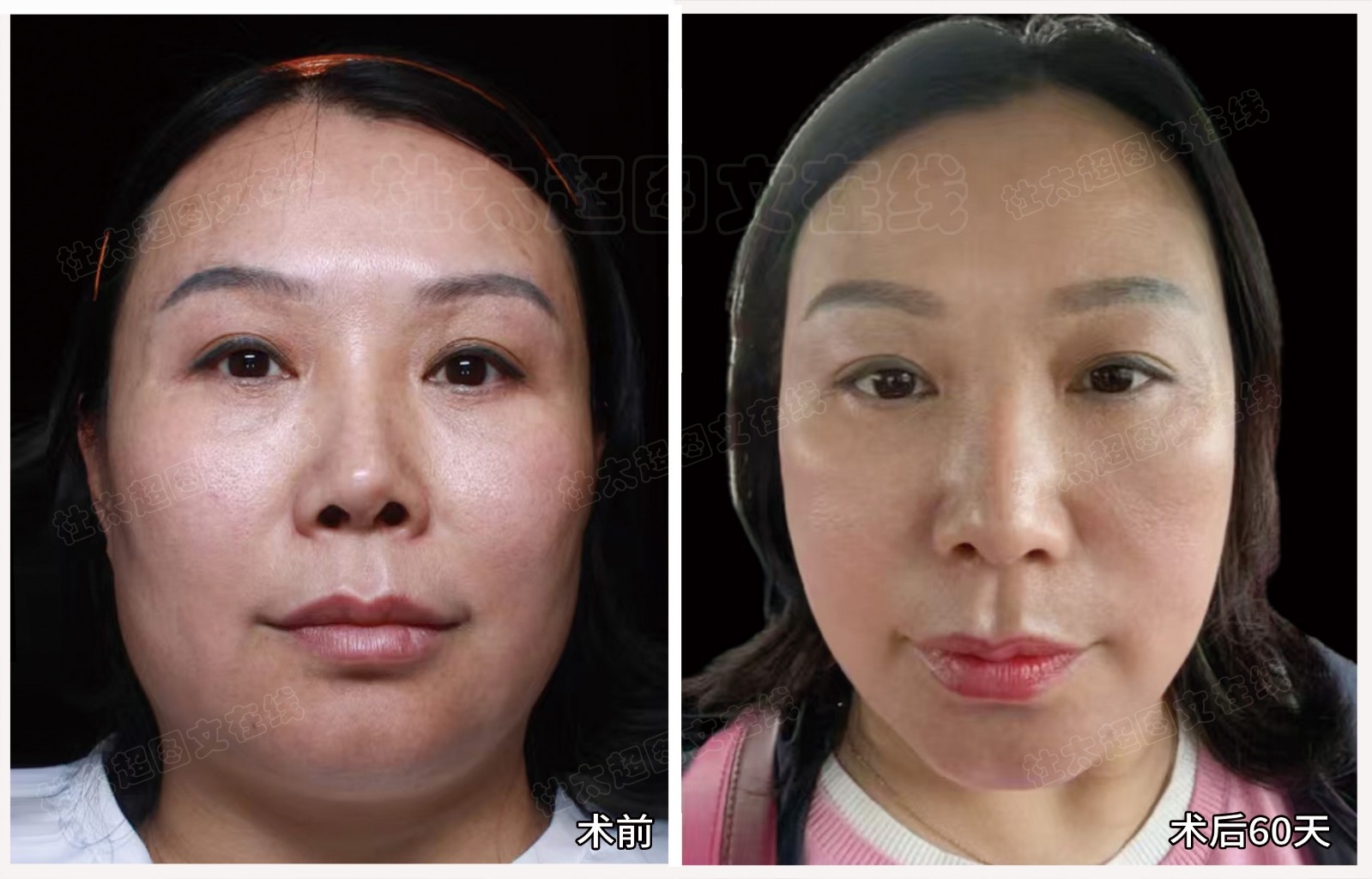 术后60天.jpg