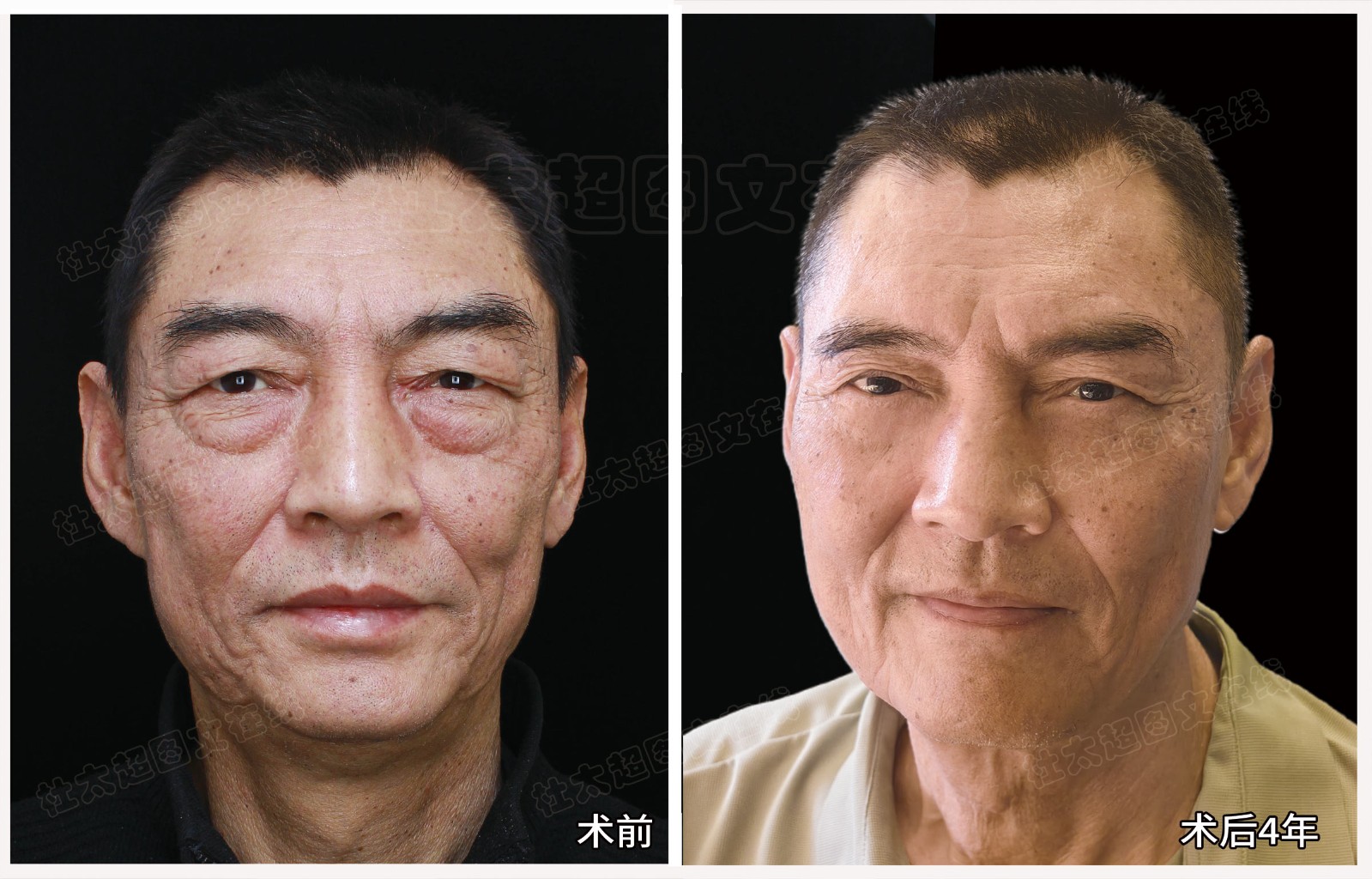 李强眼皮提升眼袋去除术后4年.jpg