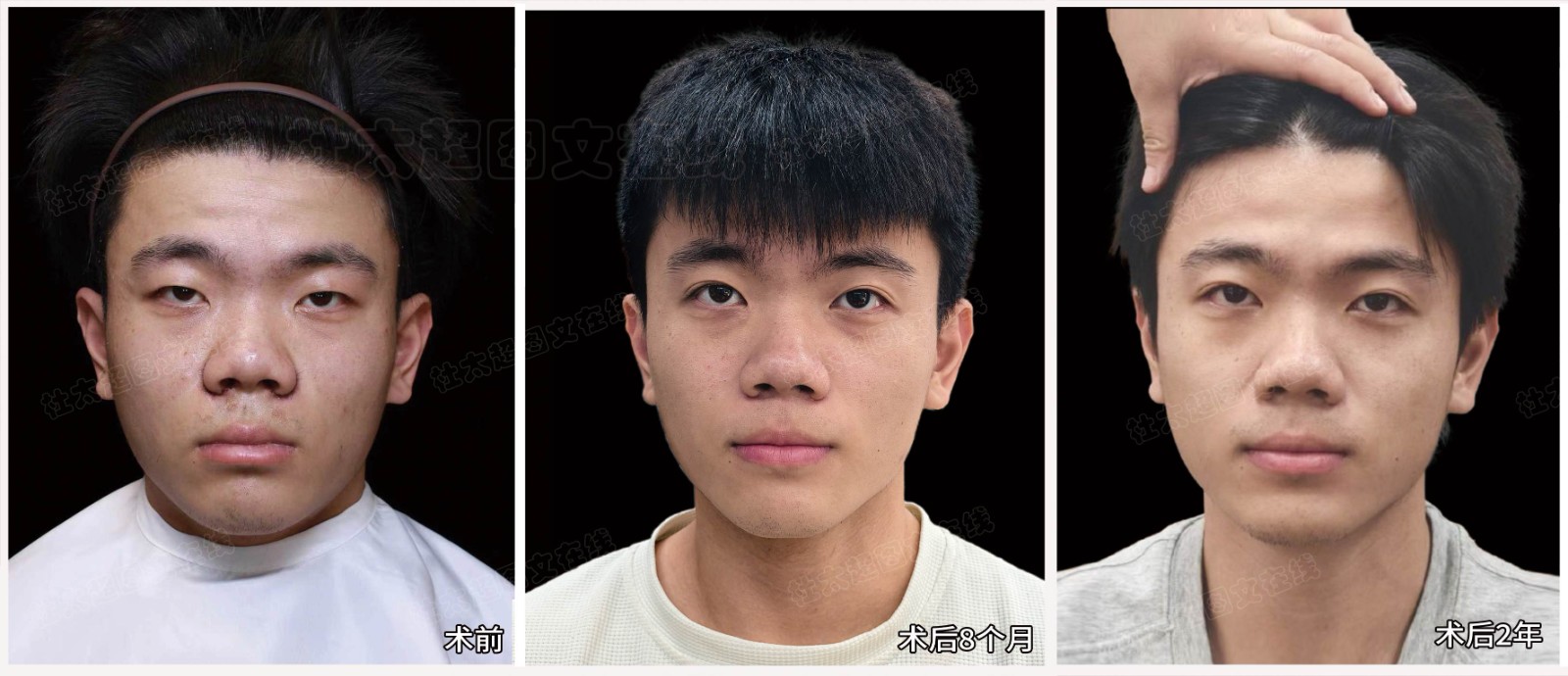 李雨橙术后2年重睑.jpg